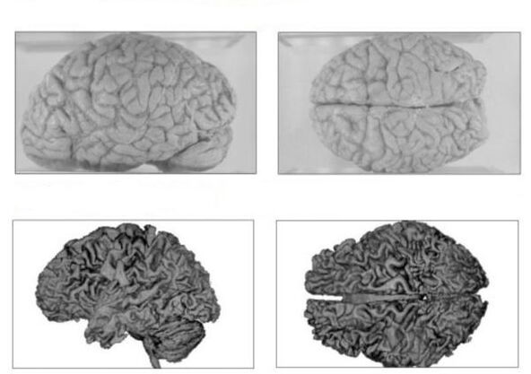 Možgani zdrave osebe (zgoraj) in možgani alkoholika z nepopravljivimi posledicami (spodaj)