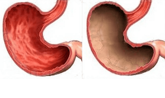 Razjeda, gastritis, rak in druge patologije želodca (na desni), katerih videz je povzročil alkohol